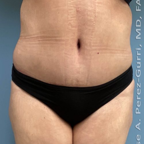 Tummy Tuck before and after - after
