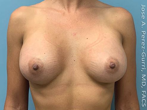 Breast Augmentation before and after - after