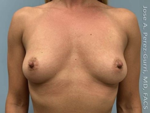 Breast Augmentation before and after - before