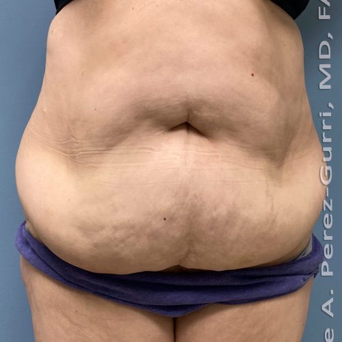 Tummy Tuck before and after - before