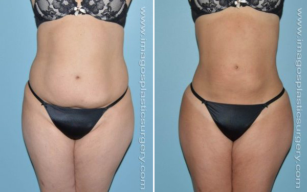 Liposuction before and after - before