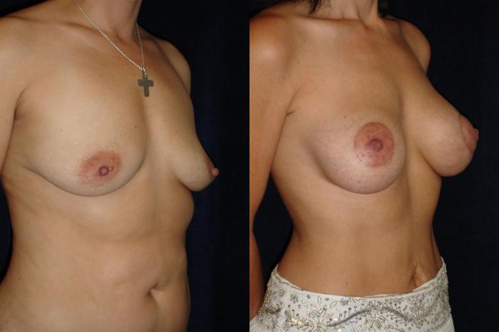 Breast Lift before and after - after