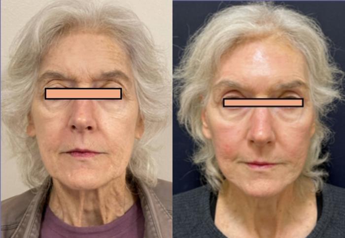 Brow Lift before and after - after