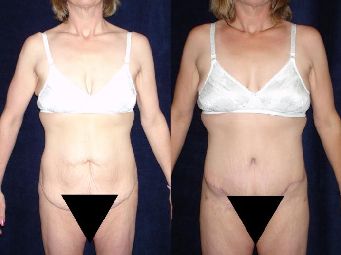 Body Contouring by Dr. Yuan Liu — before