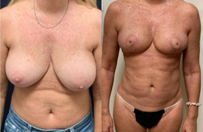 Breast Reduction before and after - before