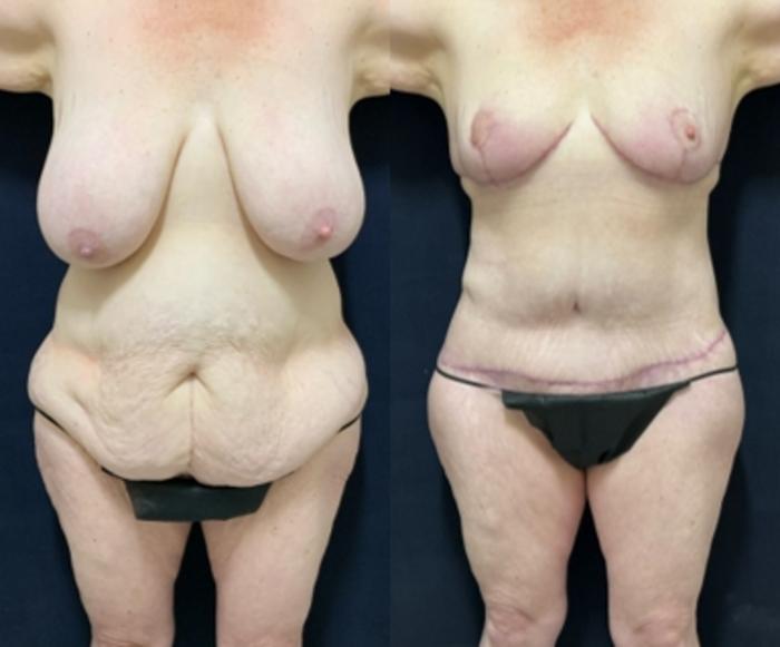 Breast Reduction before and after - before