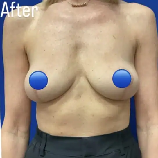 Breast Augmentation before and after - after