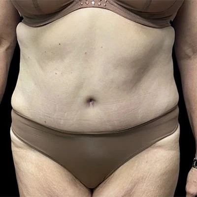 Tummy Tuck before and after - after