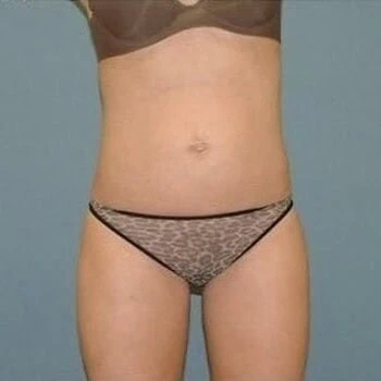 Liposuction before and after - after