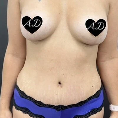 Mommy Makeover before and after - after