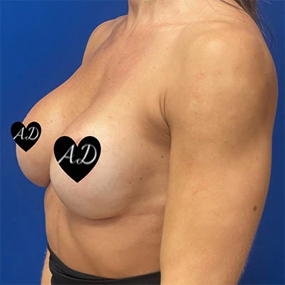 Breast Augmentation before and after - after
