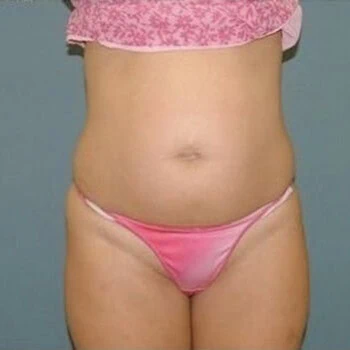 Liposuction before and after - before