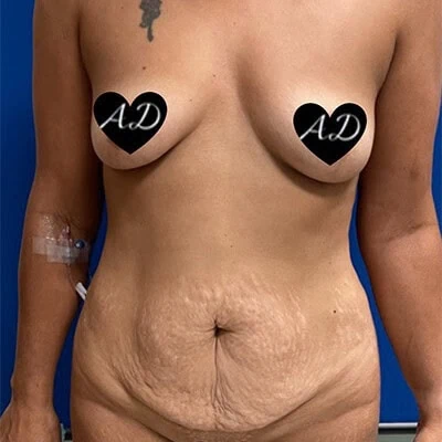 Mommy Makeover before and after - before