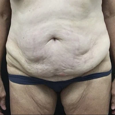 Tummy Tuck before and after - before