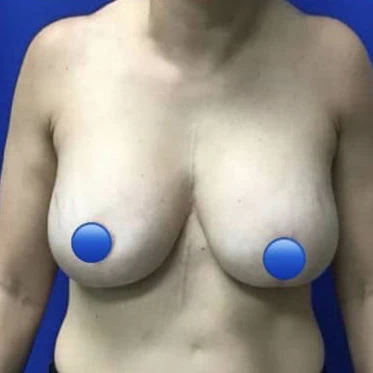 Breast Augmentation before and after - before
