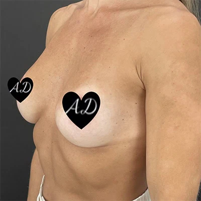 Breast Augmentation before and after - before