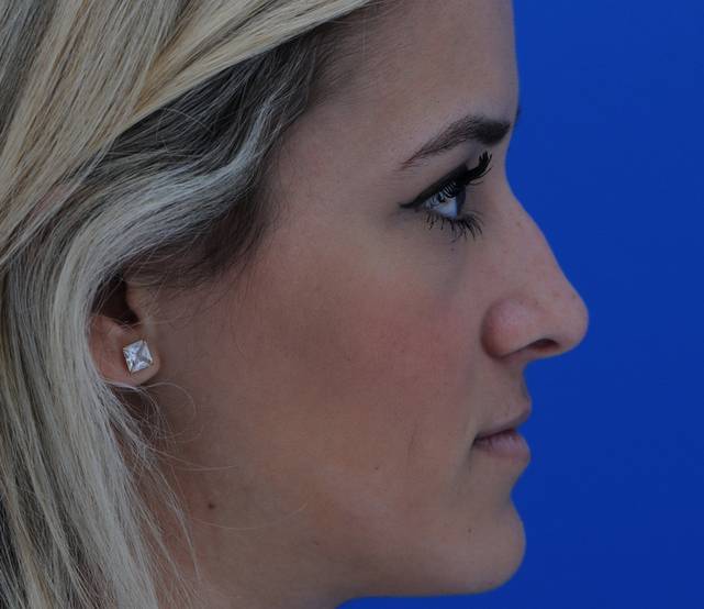 Rhinoplasty before and after - before