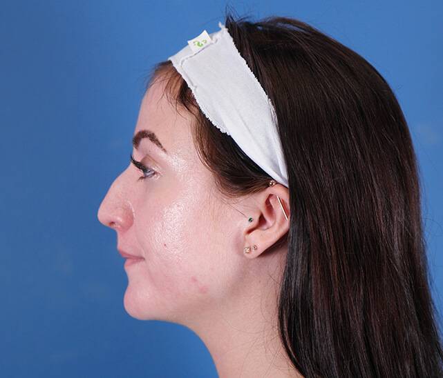 Rhinoplasty before and after - before