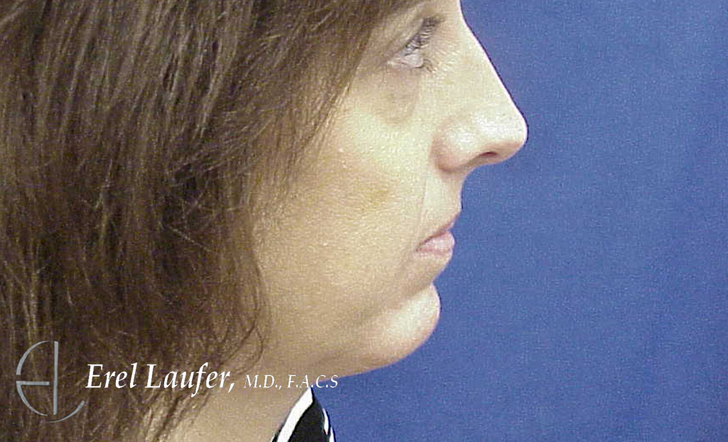 Chin Enlargement before and after - after