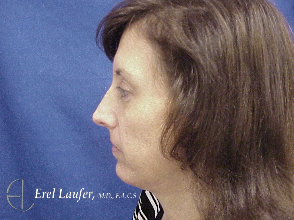 Chin Augmentation by Dr. Erel Laufer — after