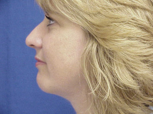Chin Augmentation by Dr. Erel Laufer — after