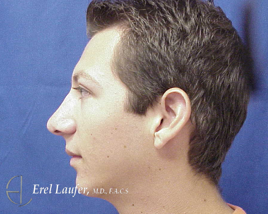 Chin Enlargement and Rhinoplasty before and after - after