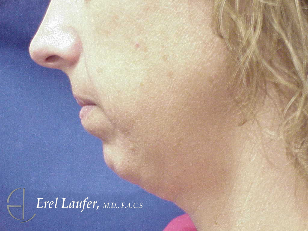 Chin Augmentation by Dr. Erel Laufer — before