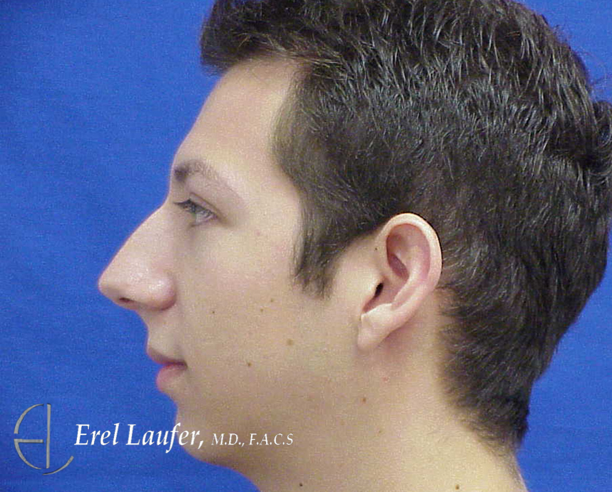 Chin Enlargement and Rhinoplasty before and after - before