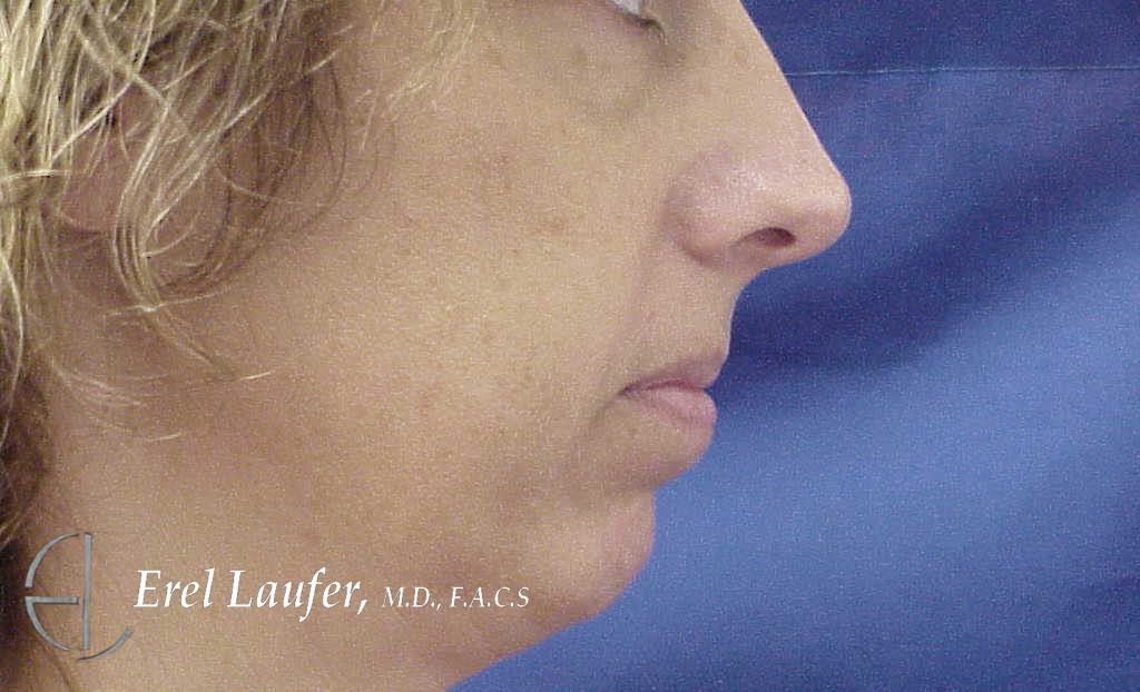 Chin Enlargement before and after - before