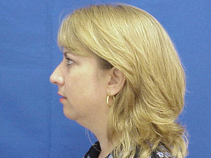 Chin Augmentation by Dr. Erel Laufer — before