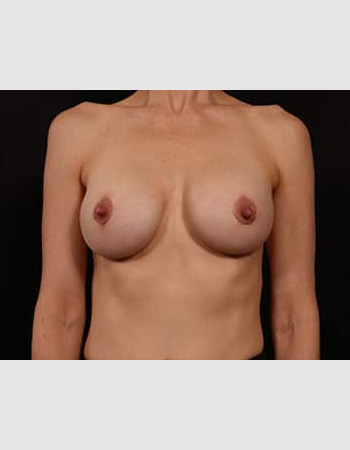 Breast Augmentation before and after - after