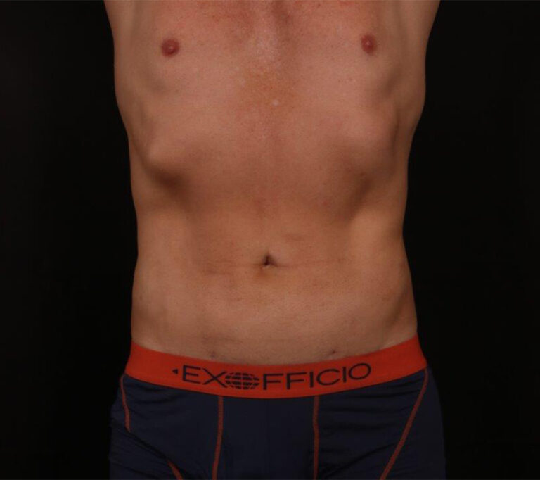 Liposuction before and after - after