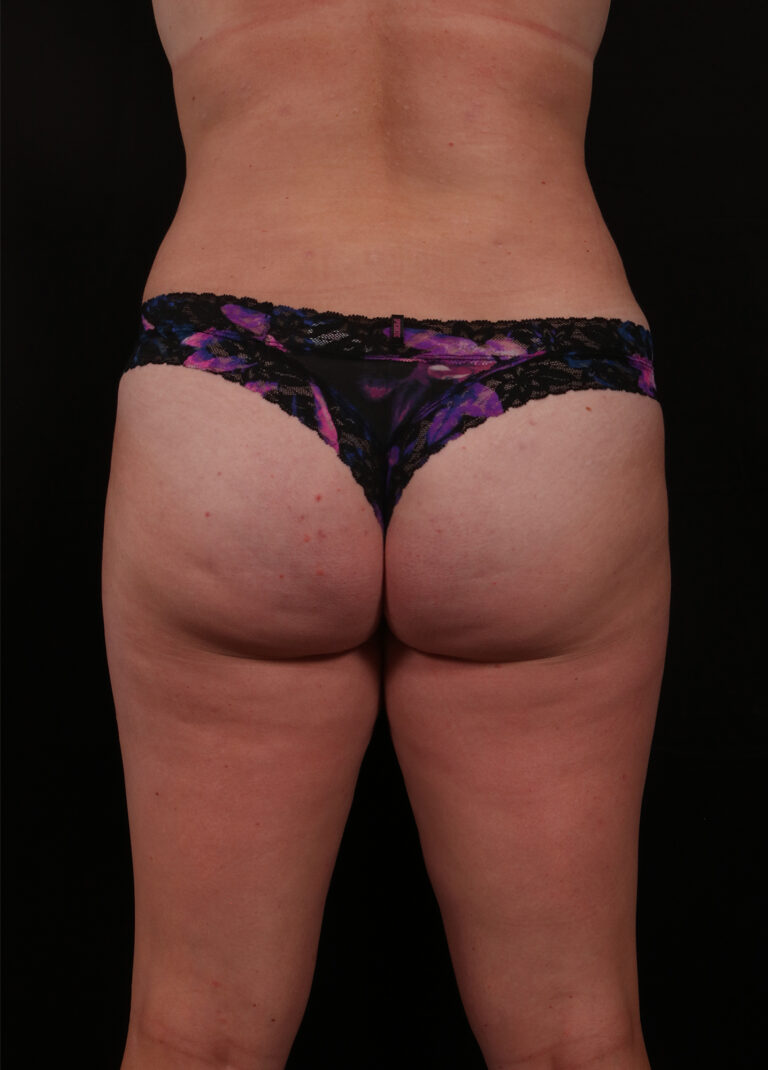 Liposuction before and after - after
