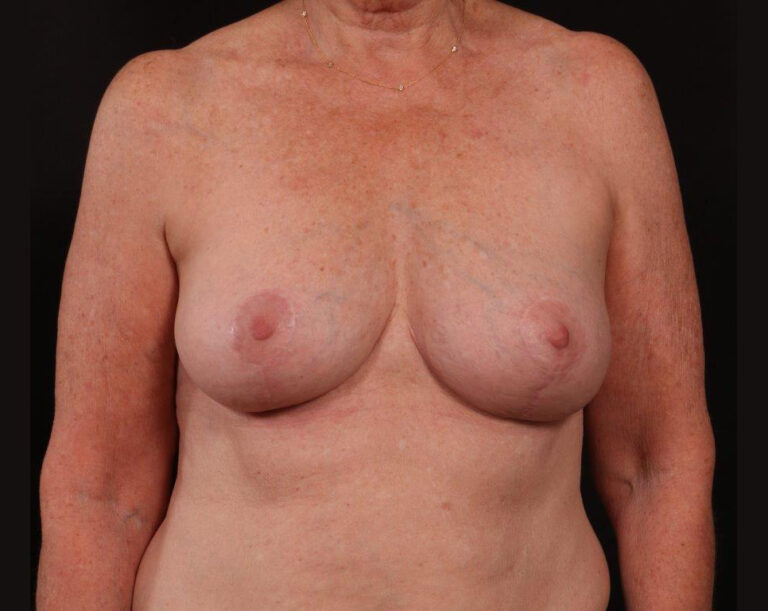 Breast Lift before and after - after