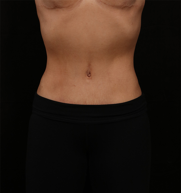 Liposuction before and after - after