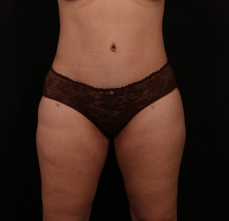 Procedure before and after - after