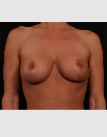 Breast Lift before and after - after
