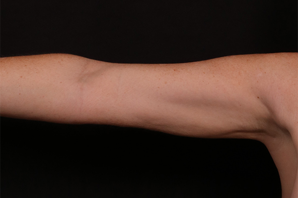 Liposuction before and after - after