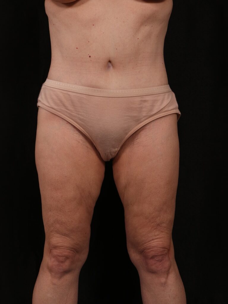 Procedure before and after - after