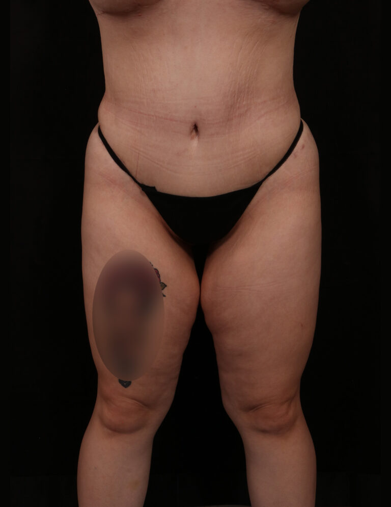 Tummy Tuck before and after - after