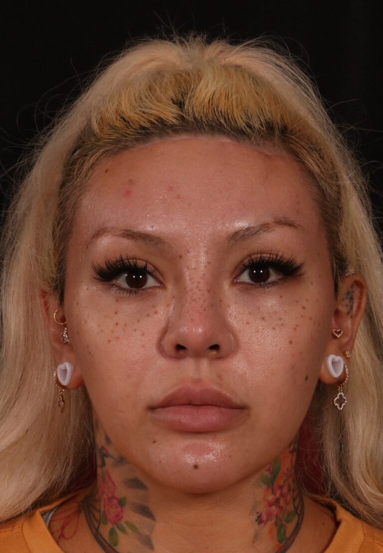 Procedure before and after - after