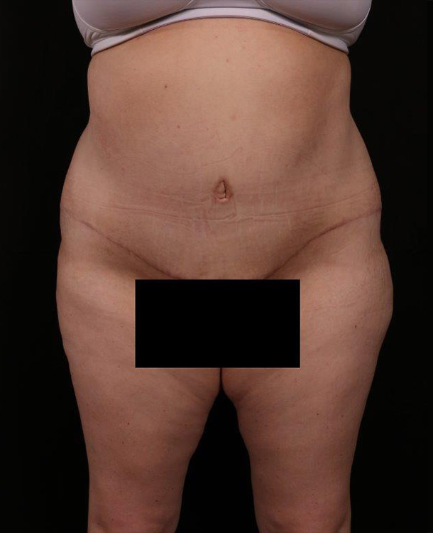 Liposuction before and after - after