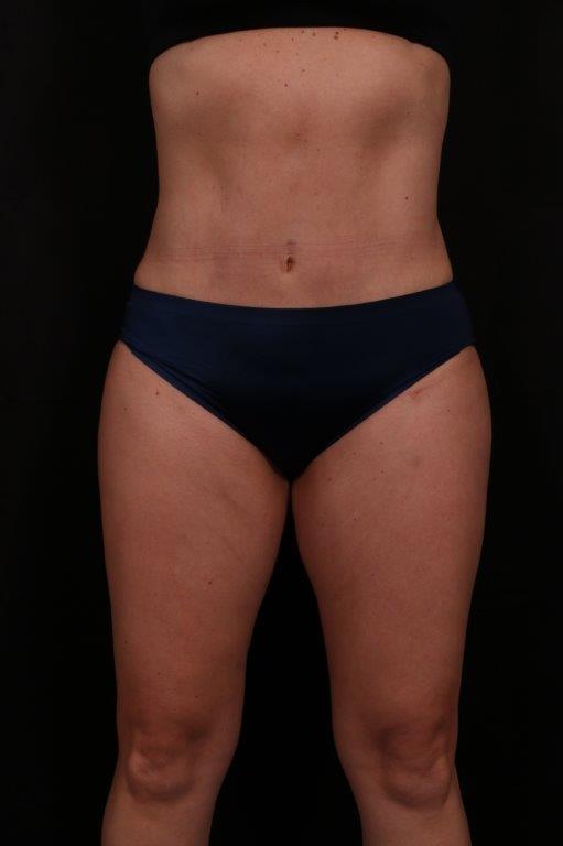 Tummy Tuck before and after - after