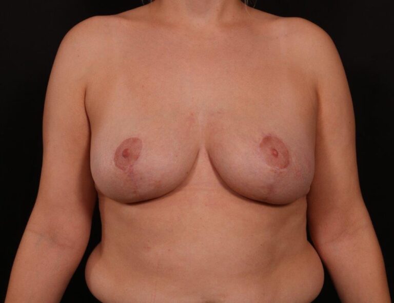 Breast Lift before and after - after