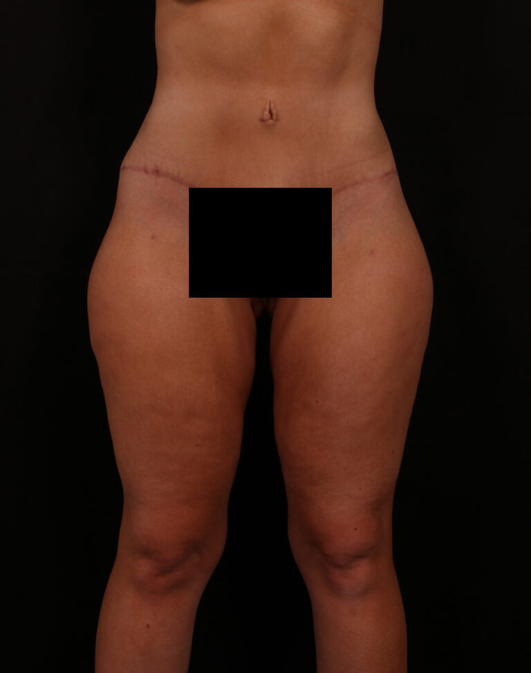 Tummy Tuck before and after - after