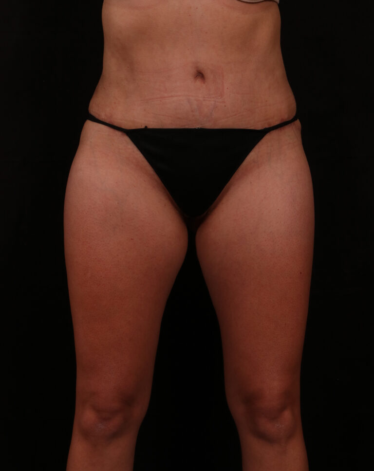 Tummy Tuck before and after - after
