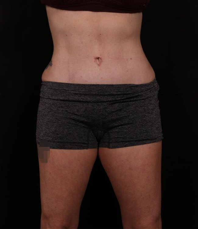 Liposuction before and after - after