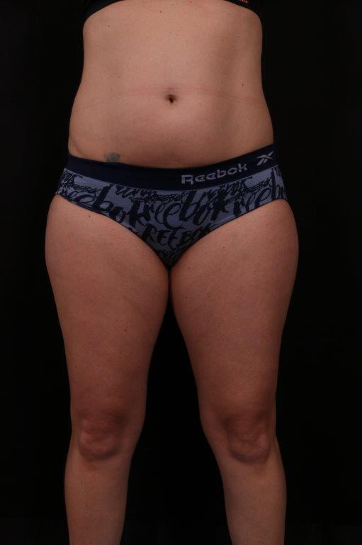 Tummy Tuck before and after - before