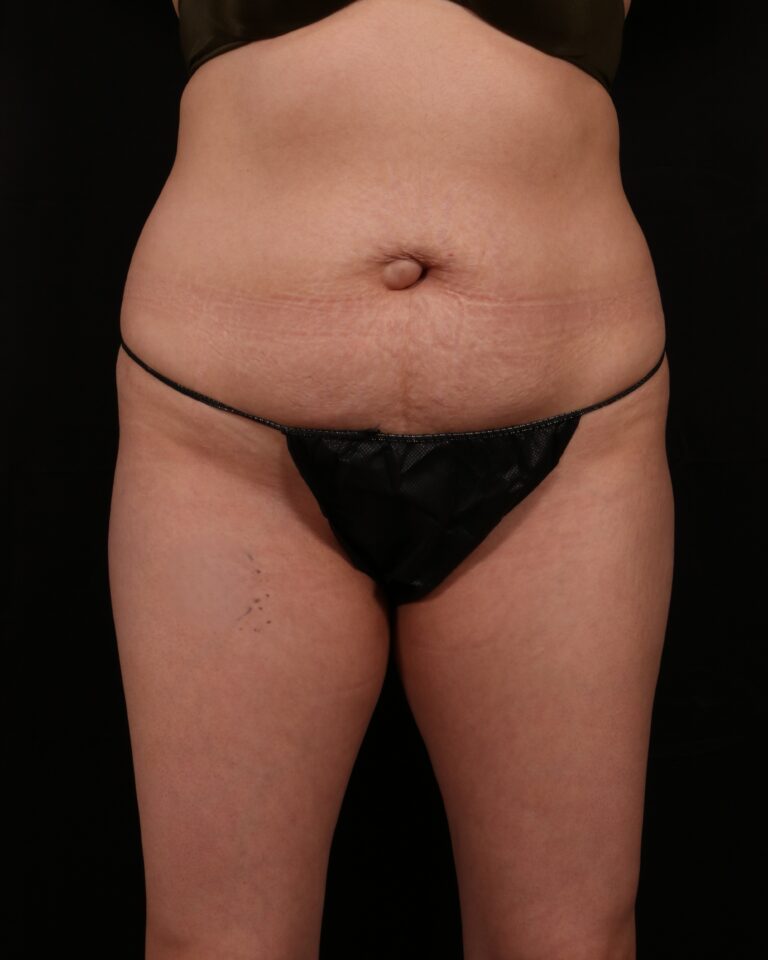 Tummy Tuck before and after - before