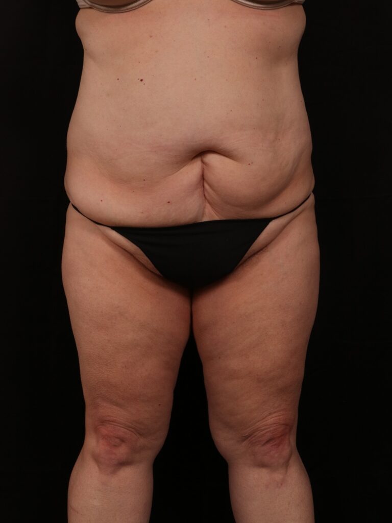 Procedure before and after - before
